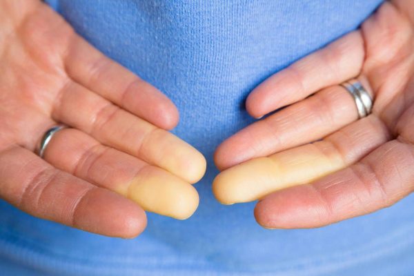 Hand Arm Vibration Syndrome